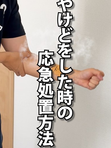 火傷の応急処置方法を紹介！