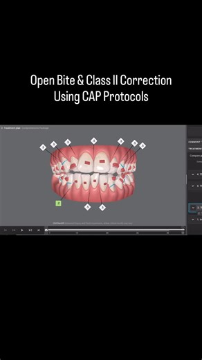 Complete Aligner Programme on Instagram: "Follow along with this ClinCheck walkthrough to see how we approach open bites and large overjets using our CAP protocols, including how we manage and refine cases during the refinement stage. We hope you find it useful and interesting. #ClinCheck #ClearAligners #OpenBite #Overjet #CAPProtocols #Orthodontics #AlignerPlanning"