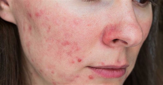 Démodécidose : quels sont les symptômes et comment se débarrasser de cette maladie de peau ?