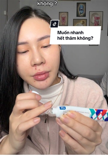 Giải pháp trị thâm mụn hiệu quả từ Azemix