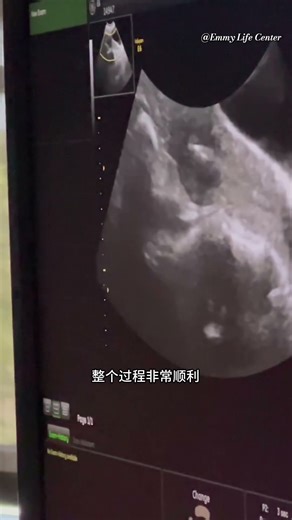 【加州合法代孕】代母确认怀孕啦！新生命蓬勃生长，恭喜我们的准父母！期待马宝宝的诞生