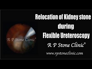 Relocation of Kidney Stone During Flexible Ureteroscopy / RIRS Surgery • Video • MEDtube.net