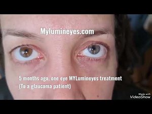 Laser Eye Color Change Surgery (Lumineyes) on a glaucoma patient! @eyecolorchange