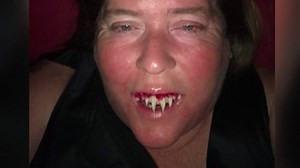 Zombie teeth: Woman gets stuck with false fangs after using super-glue