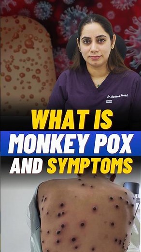 What Is Monkey POX Virus I Symptoms & Precautions