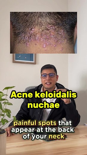 Acne Keloidalis Nuchae: Causes, Symptoms, and Effective Treatment