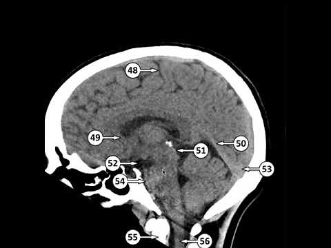 Normal CT Anatomy of the Brain - Sagittal cuts