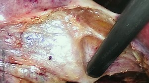Abdominal cavity inside during operation laparoscopy. Professional medical equipment in operating room. Work of surgeon doctor.