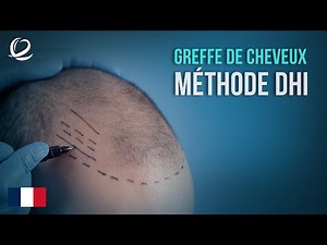 Méthode de greffe de cheveux DHI à Clinicana Istanbul, Turquie