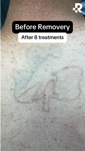 1.4K views | Tattoo removal results  Thinking about laser tattoo...