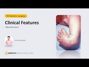 Talipes Equinovarus | Clinical Features