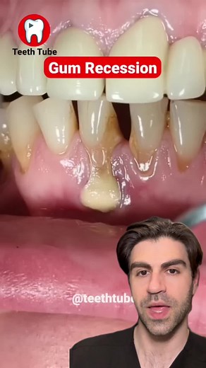 Understanding Gum Recession and Calculus Build-up on Teeth