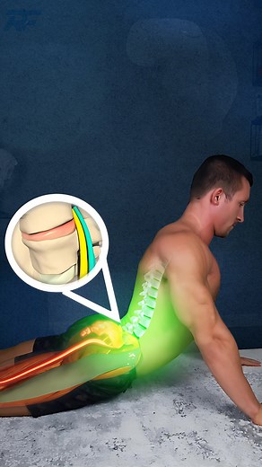 💥 3 Signs You’re Making Sciatica Worse! ❌ If you have sciatica, do you notice if these common stretches make you worse? Hamstring stretches increase back or leg pain Piriformis stretching increases glute pain or tingling Bending forward flares up symptoms even more If you notice these, you have a flexion intolerant issue, and you are making it worse if you keep doing these types of stretches! 🔑 The key is to understand that sciatica is most often caused by a disc hitting a nerve, so the first 