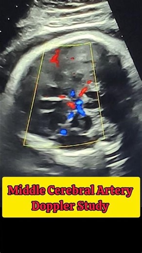 Middle Cerebral Artery Doppler Study.#fetalultrasound