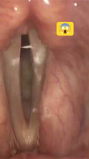 What Your Throat Looks Like From the Inside | 3D Medical Animation of the Human Throat