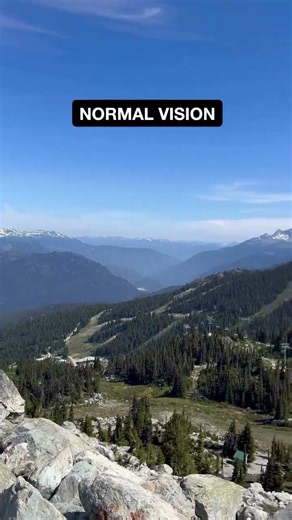 How Cataracts Change Your Eyesight | Normal vs Early vs Advanced Cataract Vision Simulation