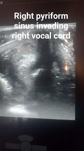 right pyriform sinus cancer or hypopharyngeal cancer