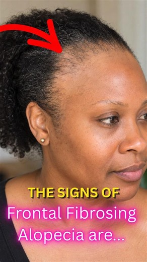 🤔 WHY Are So Many Women Losing Their Hairline? (What Is FFA?) #haircare