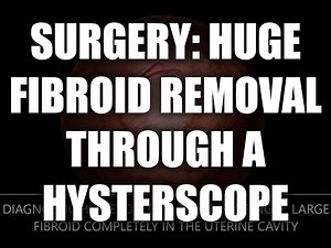 Surgery: Hysteroscopic myomectomy - Hologic Myosure Reach