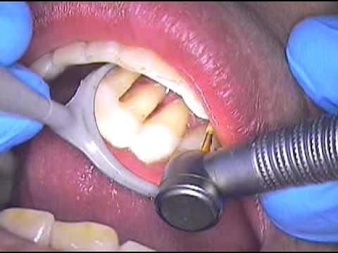 4. Dental Splinting - Conservative approach to strengthen teeth and reposition a lower incisor