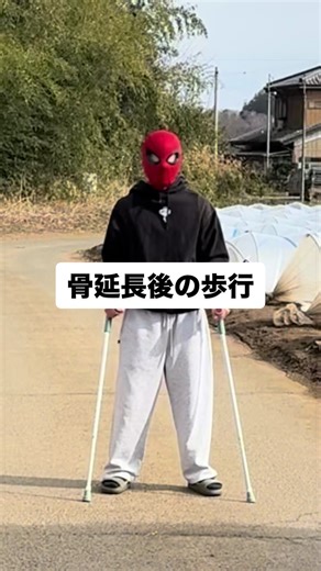 骨延長後の歩行の様子です。 終了から約1ヶ月が経ちました。 どうでしょう。 意外と歩けてると思いませんか？ これでも大腿骨が折れてる状態なんですよ。 釘で固定はしていますが。 普段はこの杖かシルバーカーを使って歩行の練習をしています。 歩き方忘れました。 ちなみにこれだけでもめちゃくちゃ疲れます。 体力の衰えがすごい。 もっと歩けるようになるのが楽しみです。✌🏻 ※背景が田舎すぎるのは気にしないでください #骨延長 #整形 #リハビリ #spiderman #散歩