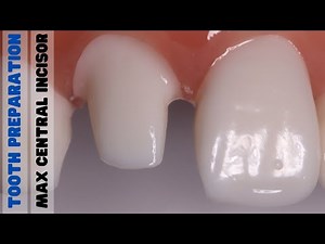 Tooth Preparation For A Crown - Maxillary Central Incisor • Video • MEDtube.net