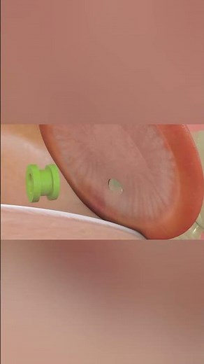 OTITIS MEDIA: Quick Review: What you need to know #animation #otitis #earinfection