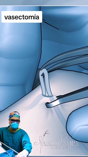 Operación de Vasectomía: Procedimiento detallado y paso a paso