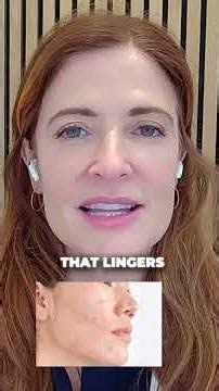 Why retinoids actually work for acne...