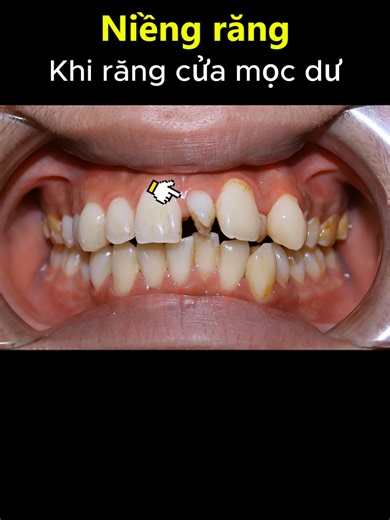 Niềng răng trường hợp răng cửa mọc dư.#niengrang #chinhnha #nhakhoa #braces #orthodontics
