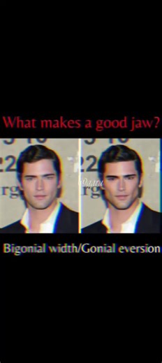 Understanding Gonions: Jaw Angle Anatomy