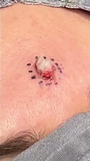 Cyst Like a Marshmallow Cloud