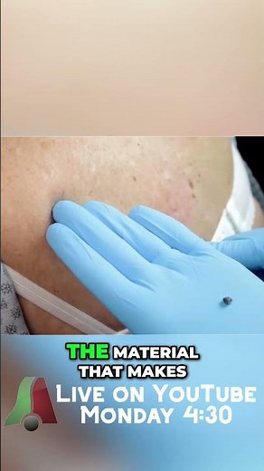 Satisfying Blackhead Extraction: The Ultimate Zit Popping Guide! #shorts