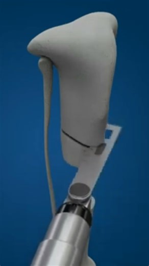 𝗨𝗻𝗯𝗶𝗮𝘀𝗲𝗱 𝗜𝗻𝗳𝗼 𝗔𝗯𝗼𝘂𝘁 𝗣𝗹𝗮𝘀𝘁𝗶𝗰 𝗦𝘂𝗿𝗴𝗲𝗿𝘆 on Instagram: "Distraction osteogenesis is an advanced surgical technique that gradually lengthens bones using external fixators. The process involves performing an osteotomy (cutting the bone) and then gradually separating the bone segments, allowing new bone to form. While this method is used in orthopedics to correct deformities, treat complex fractures, and for reconstructive surgery, it has gained popularity in South Korea a