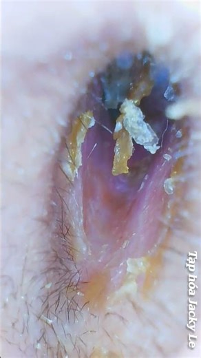 Lấy Ráy Tai Thư Giãn #231 #asmr #satisfying #earcleaning #extraction #earwax #earwaxremoval