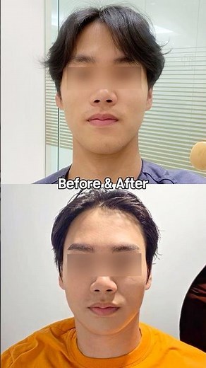 남자 턱끝축소술(긴턱수술) #입체성형외과 #shorts