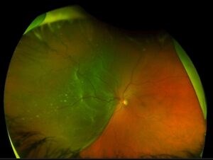 Retinal Detachment, Retinal Detachment Treatment, Retinal Detachment Symptoms