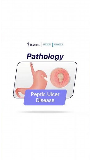 Peptic Ulcer Disease | Pathology | BioAtlas