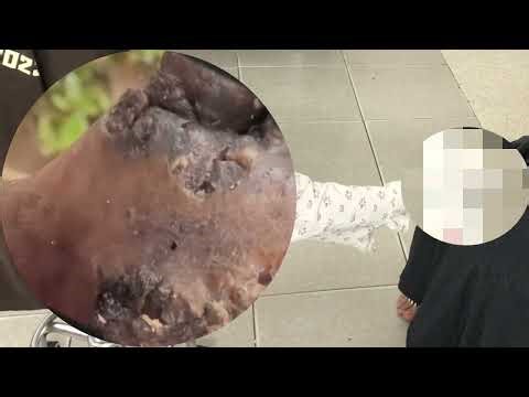 😵 Jigger Infestation Nightmare – Crawling Out Alive! #DN010