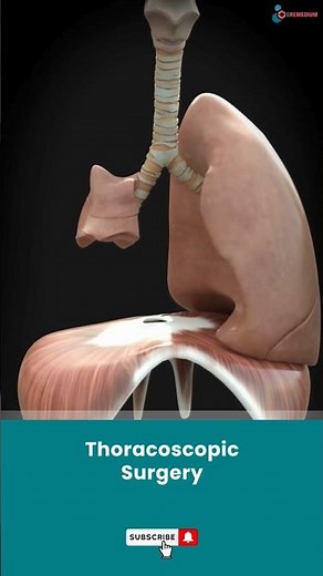 Video-Assisted Thoracoscopic Surgery (VATS)↪3D Medical Animation #Shorts #ThoracoscopicSurgery #VATS