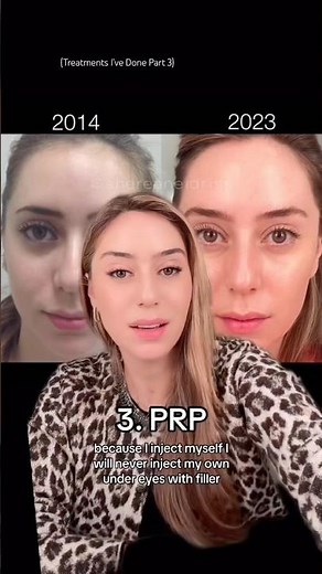 How I treated my hollow under eyes as a cosmetic dermatologist
