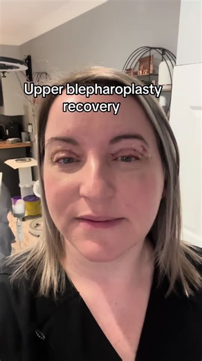 Upper Blepharoplasty Recovery: Day 7 Progress