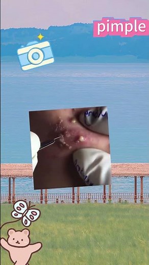 Severe Acne Treatment: Pimple Popping and Extraction#acnetreatment #pimplepopping