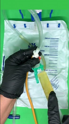 Urine Collection from a Urinary Catheter: The Secret to Avoiding Contamination!