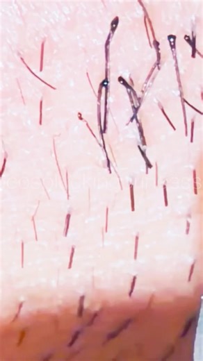 #satisfying #tweezer #beard #plucking #facialhair #moustache #ingrownhair