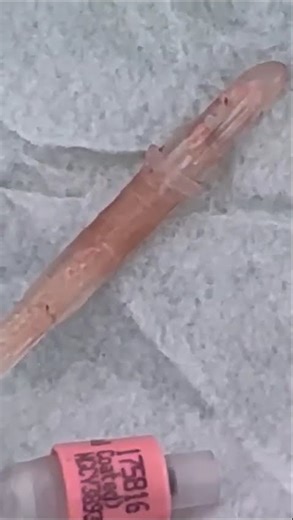 Spinal cord injury SPC catheter completely stuck inside, blocked & crystallised !