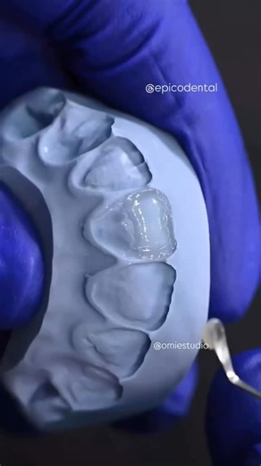 Dentistry Everyday on Instagram: "Direct Composite Veneers (step-by-step) The Reel worth saving! • • • All Credits to @epicodental ➖ • #dentistry #dental #dentist #dentists #dentalstudent #dentalhygienist #dentalart #doctor #doctors #toothimplant #dentalrestorations @dentistry.everyday #dentalboards #dentalradiography #dentalveneers #dentalclinic #dentalclinicdesign #dentalimplants #teeth #tooth #dent #dentallogo #dentalassistant #dentalcare #dentalinstruments"