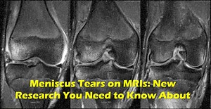 Meniscus Tear MRI: Understanding Knee Health