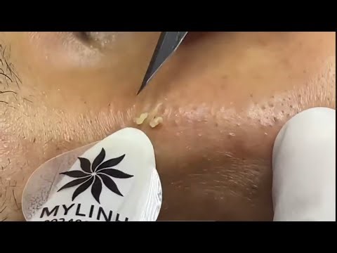 Mylinh . Most Satisfying Pimple Popping Ever #551