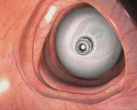 Aer-O-Scope - How does the procedure work?